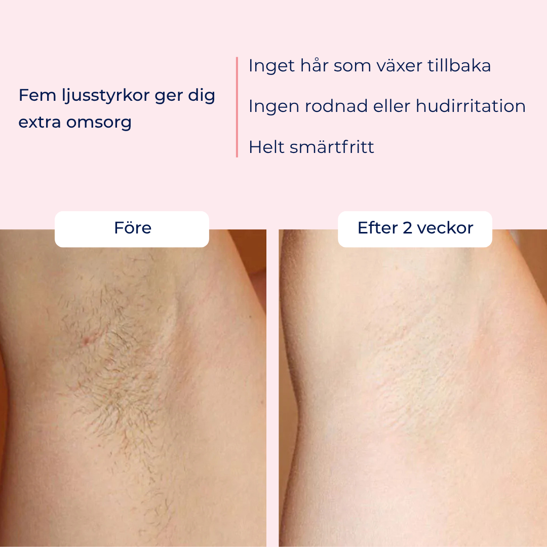 MinFjora FlashPro IPL – Hårborttagning för kropp & ansikte